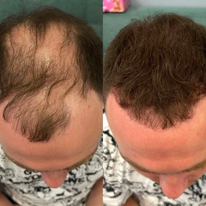 SafeHair® – Sofort volleres Haar in 5 Sekunden